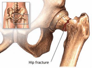 bone fractures in human