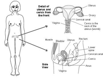 cervical cancer