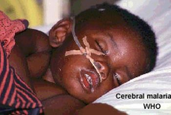 child suffering from cerebral malaria 9