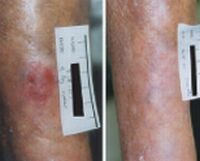 effect of pep005 topical gel shown