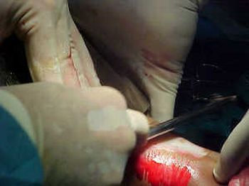 skin grafting