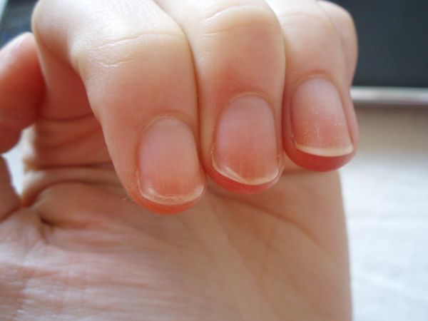 Peeling-Nails