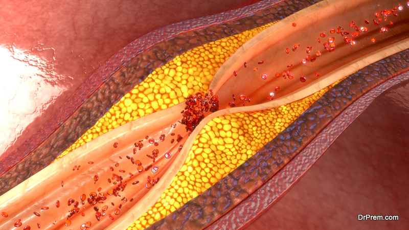 cholesterol-clots